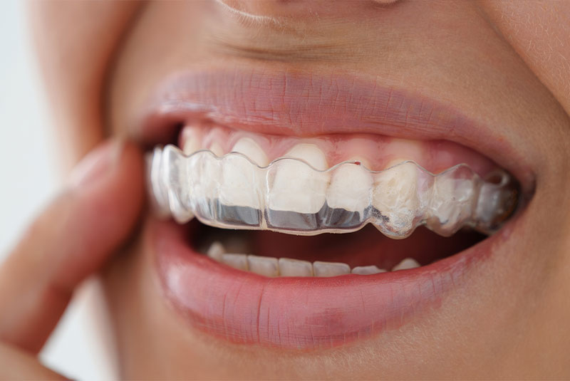 close up of person putting on their aligner