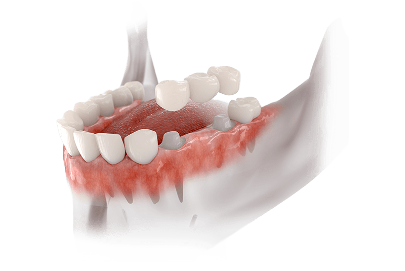 Bridge dental with 3 teeth fixed on molar and premolar