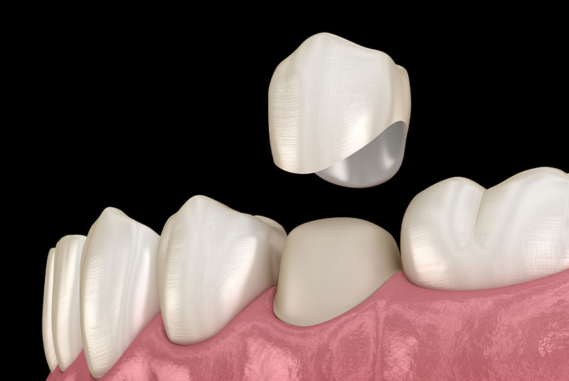 illustration of dental crown