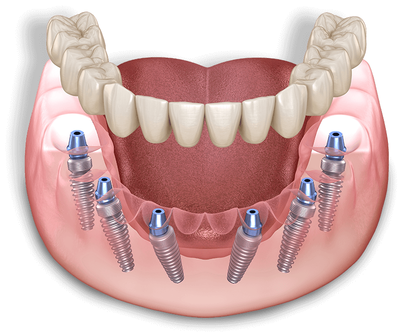 all on x full mouth dental implant model