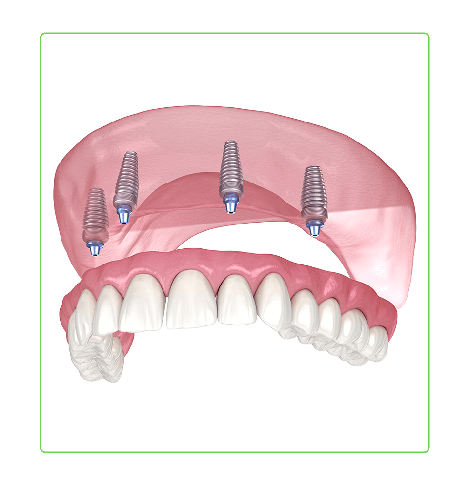 illustration of implant supported dentures