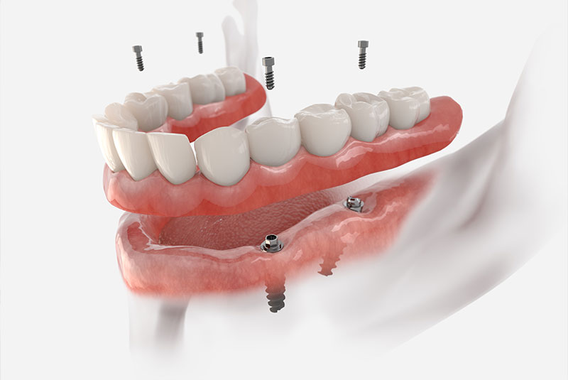 illustration of dental implant