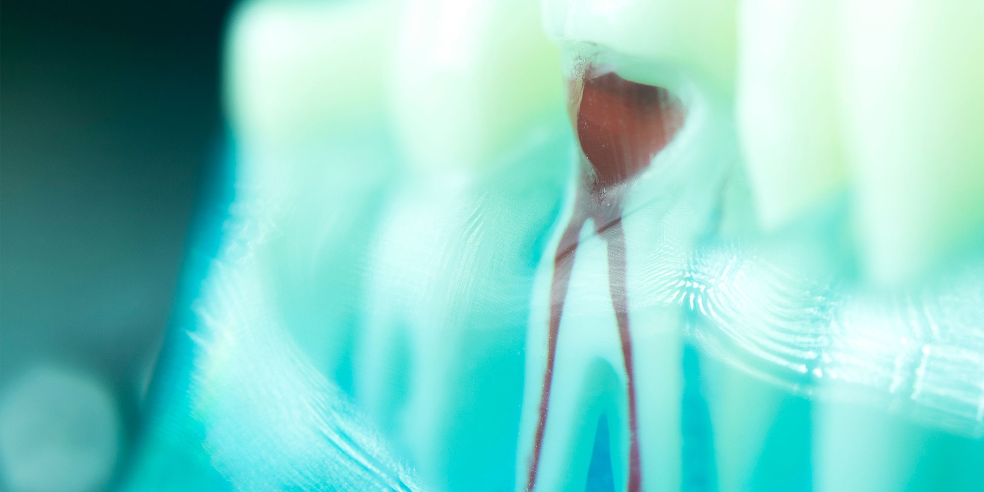 close up of root canal